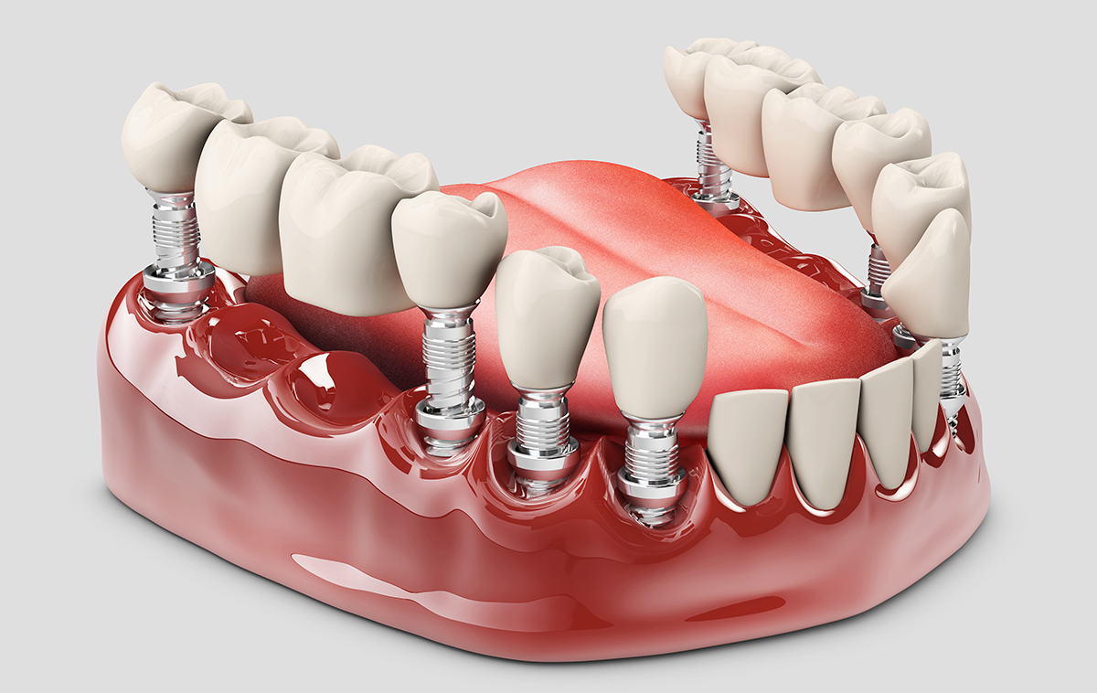 root canal treatment in pudukkottai